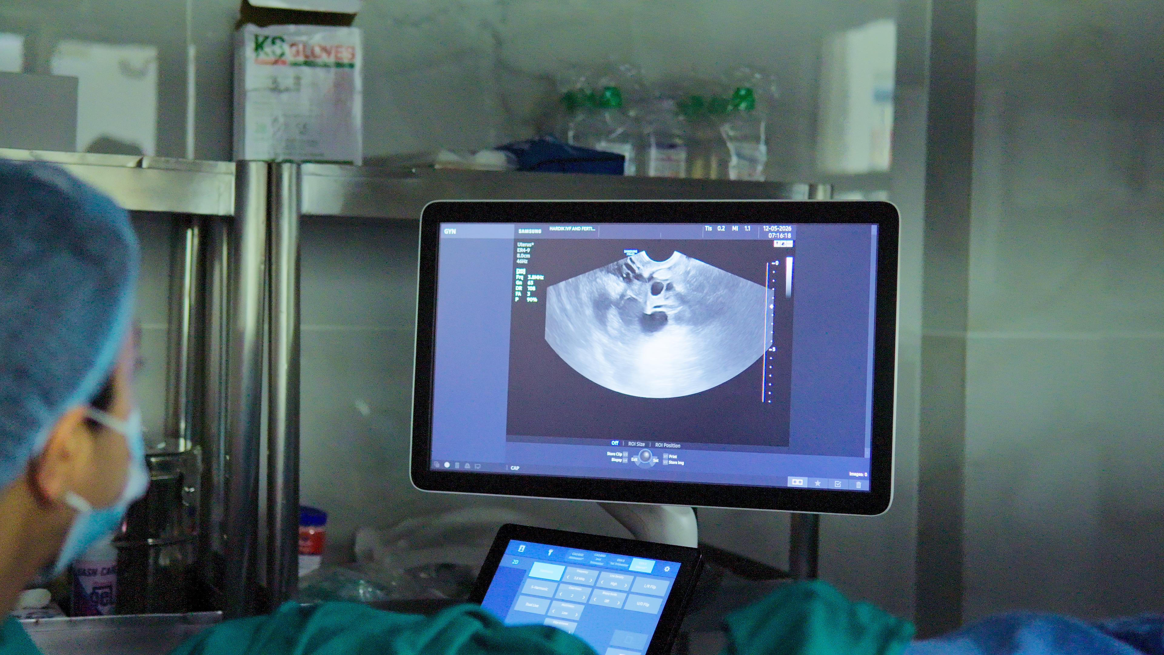 Follicle Monitoring